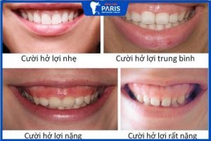 3 Mức độ cười hở lợi – Bạn đang ở mức mấy – Cách cải thiện nhanh