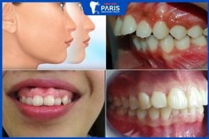 5 Bước chỉnh hàm hô đơn giản – Những lưu ý sau khi phẫu thuật hàm