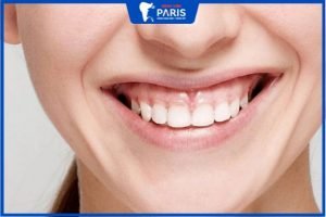 Chữa cười hở lợi giá bao nhiêu? Bệnh viện răng hàm mặt Paris