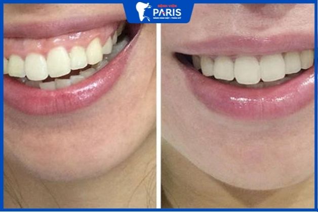 Cười hở lợi là gì?