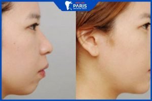 Chữa hàm hô không phẫu thuật – Giải pháp tối ưu khi bị hô do răng