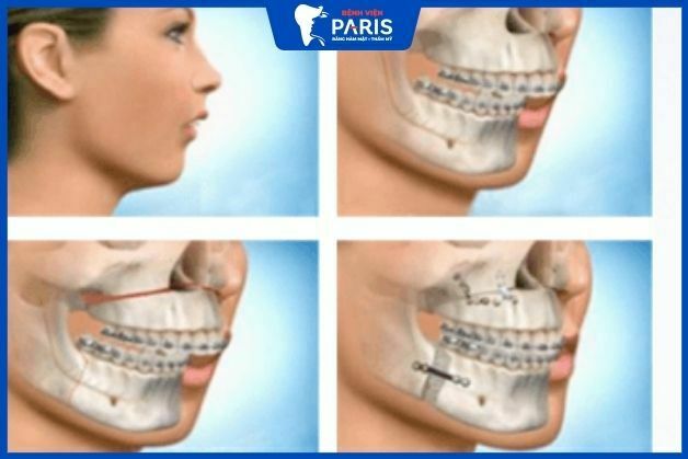 Nên thực hiện chỉnh răng hô không cần phẫu thuật ở đâu?