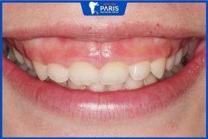 Cười hở lợi là gì? Nguyên nhân và cách khắc phục