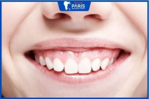 4 Phương pháp chữa cười hở lợi hàm trên cải thiện tướng số