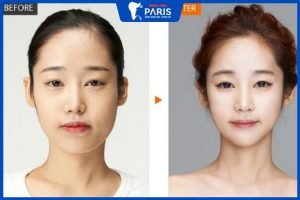 Gọt cằm có đau không? Bác sĩ nha khoa giải đáp và cho lời khuyên