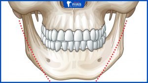 Phẫu thuật gọt hàm có đau không? Có nguy hiểm không