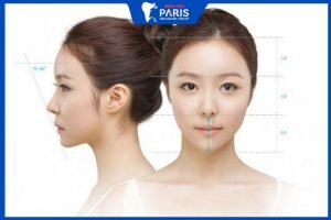 Gọt hàm VLine: Giải pháp tối ưu cho khuôn mặt đẹp thon gọn