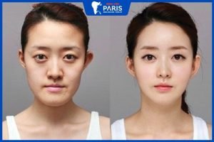 Gọt hàm vuông như thế nào? Có đau, nguy hiểm không ? Cách chăm sóc