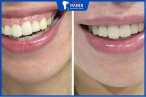Phẫu thuật cười hở lợi giá bao nhiêu | Bảng giá chi tiết