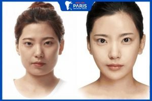Phẫu thuật gọt cằm V line có đau lắm không? Giá bao nhiêu/ca?