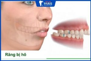 Phẫu thuật hàm có nguy hiểm không? Quy trình cắt, gọt xương hàm