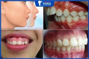 Phẫu thuật hàm hô và 5 điều cần biết trước khi vào phòng mổ