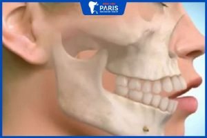 Phẫu thuật hàm hô móm không nhổ răng: Đẹp, an toàn, ít đau