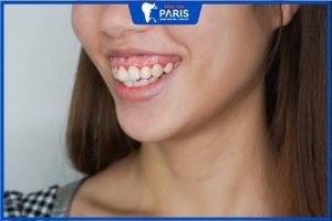 Răng ngắn cười hở lợi là gì? Cách chữa trị dứt điểm