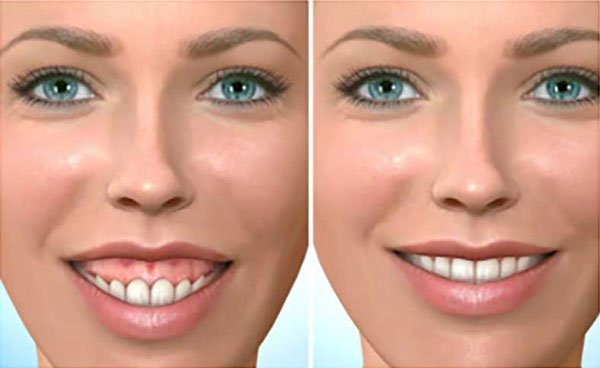 Đây cũng là lời giải đáp cho thắc mắc cắt nướu cười hở lợi mất bao lâu của nhiều khách hàng. 