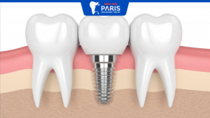 Giá implant bệnh viện răng hàm mặt chuẩn và yếu tố ảnh hưởng