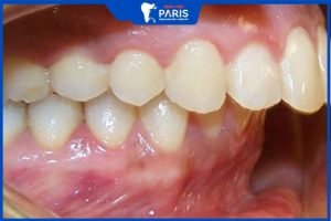 Phẫu thuật hàm móm- Giải pháp “LỘT XÁC” Hoàn Hảo