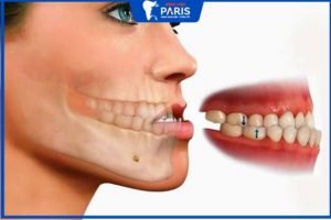 3 Phương pháp Điều trị chữa hàm móm nhẹ