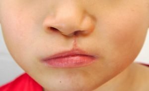 Địa chỉ phẫu thuật hở hàm ếch ở đâu tốt nhất – Uy tín nhất