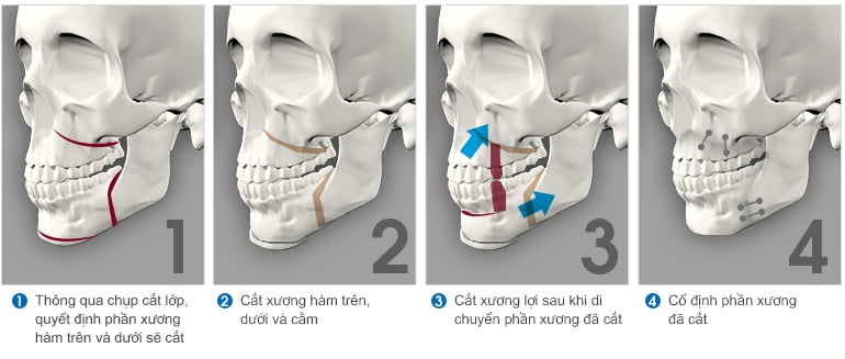thao tác chính trong phẫu thuật chỉnh hình hàm mặt
