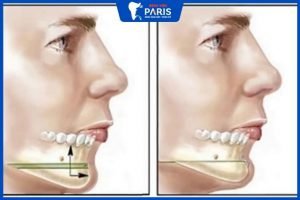 Phẫu thuật hàm dưới: Giải Pháp Giúp Bạn LỘT XÁC Cuộc Sống