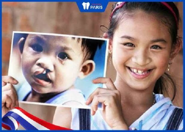 Trước khi phẫu thuật hở hàm ếch