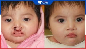 Phẫu thuật môi hàm ếch thời gian nào tốt nhất? Cha mẹ chuẩn bị gì?