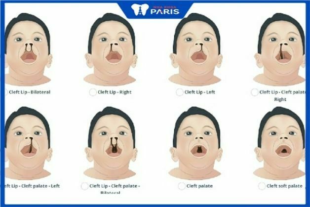 Biểu hiện môi hàm ếch