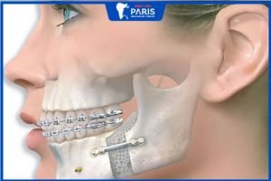 Tổng quan về phẫu thuật hàm – Chuyên gia chia sẻ 7 thông tin