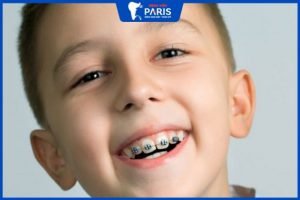Trẻ bị hô hàm: dấu hiệu nhận biết sớm và cách khắc phục triệt để