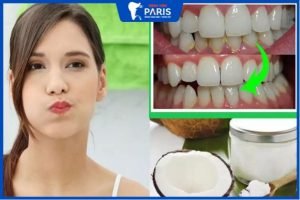 18 cách lấy cao răng tại nhà bằng nguyên liệu tự nhiên