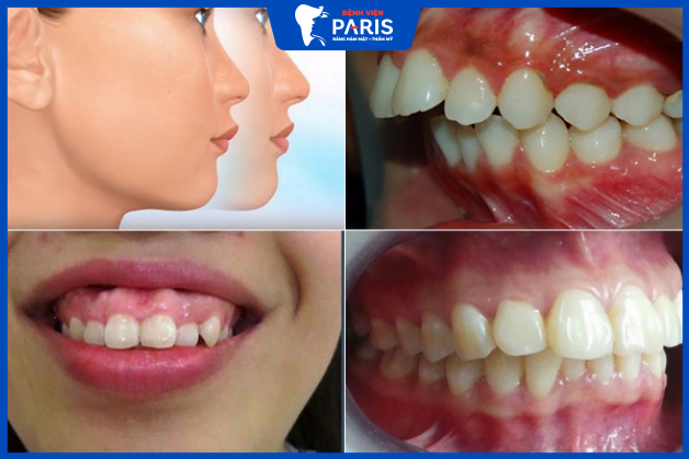 Phẫu thuật chỉnh hàm hô là cải thiện tốt tình trạng hàm hô