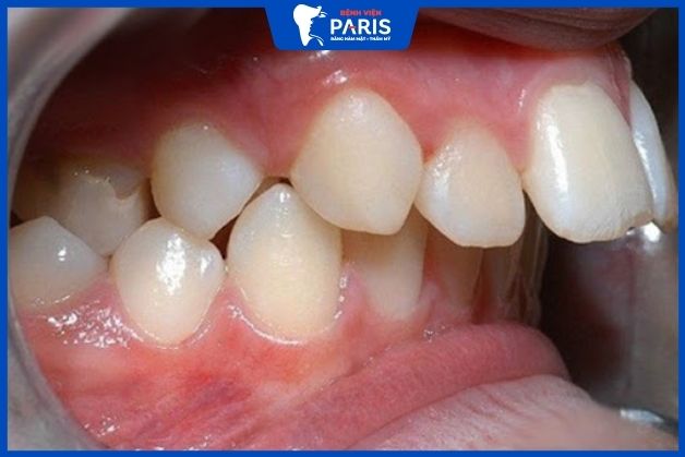 Dấu hiệu răng bị hô nặng
