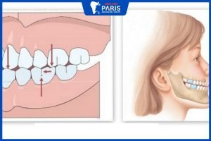 Phẫu thuật hàm móm có nguy hiểm không, cần lưu ý những gì?