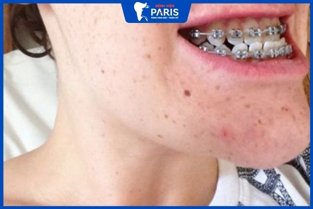 Niềng răng sớm càng rút gọn thời gian điều trị
