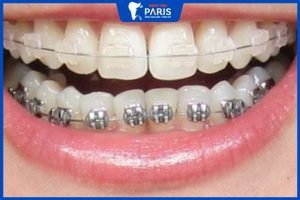 Niềng răng móm hàm có hiệu quả không? những điều quan trọng cần biết