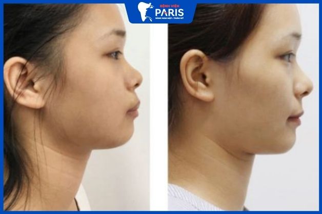 Khách hàng tự tin với khung hàm cân đối sau niềng