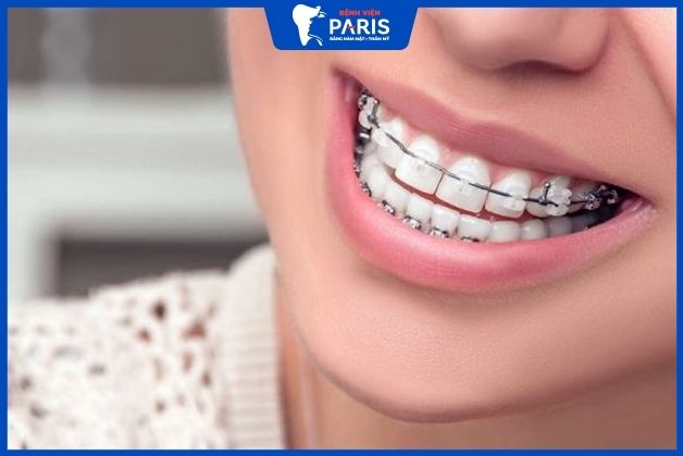 Hàm móm có niềng răng được không ?thời gian và chi phí niềng