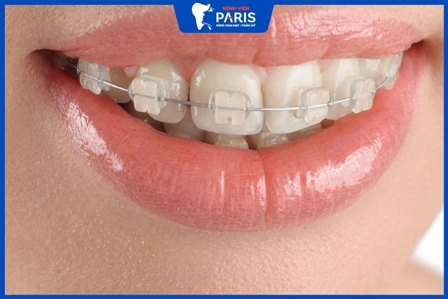 Niềng răng mắc cài giúp răng dịch chuyển nhanh hơn, tiết kiệm chi phí