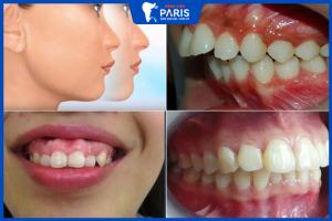 Hàm hô: Nguyên nhân, đặc điểm và phương pháp cải thiện