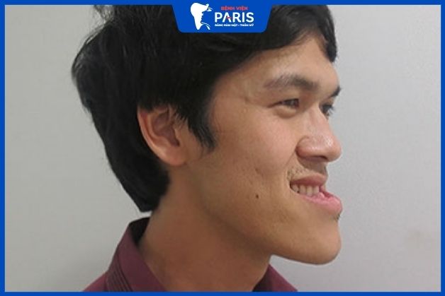 Miệng móm xấu hay đẹp