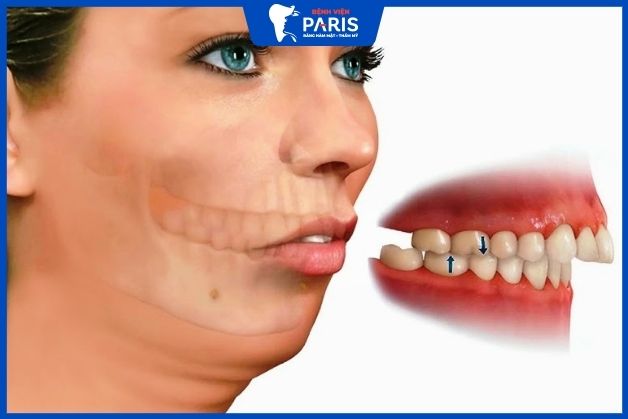 Nguyên nhân dẫn đến hàm hô móm