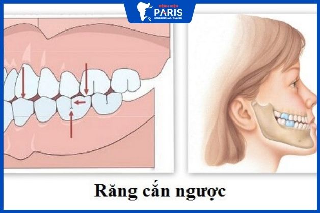 Khớp cắn là điểm quan trọng nhất mà bạn cần lưu ý khi phẫu thuật