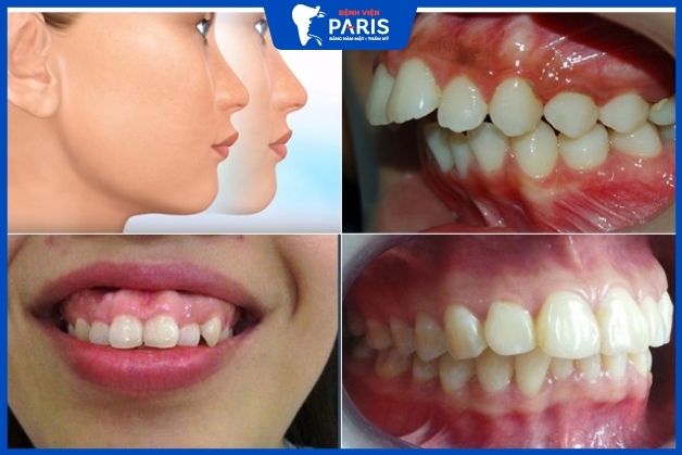 Trẻ bị hô hàm là tình trạng hàm trên phát triển quá mạnh so với hàm dưới