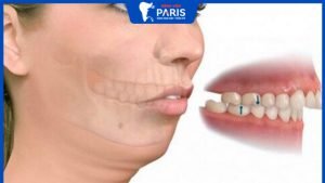 2 Cách nhận biết răng hô nặng hay nhẹ dễ dàng và pháp đồ điều trị