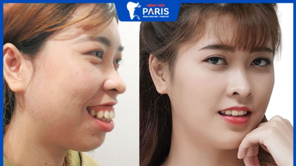 Phương pháp chỉnh hàm hô không phẫu thuật hiệu quả kịp thời