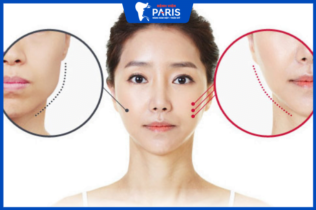 Gọt cằm cải thiện đường nét khuôn mặt thêm thon gọn hơn