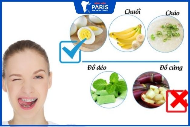 Ăn đồ mềm, dễ nuốt trong quá trình niềng răng chữa hàm hô không phẫu thuật