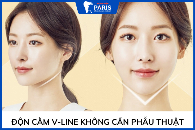 Độn cằm V-line không cần phẫu thuật – Xu hướng làm đẹp 2022