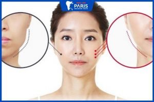 Gọt hàm có ảnh hưởng về sau không? Lưu ý quan trọng